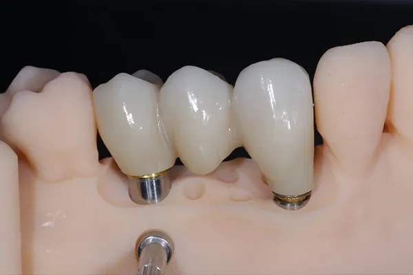 ZIRCONIO-MONOLITICO-SOBRE-IMPLANTES